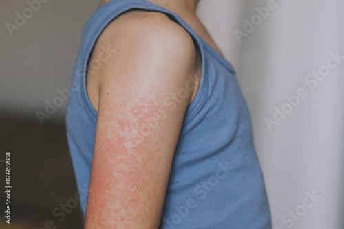 Canvastavla Children's allergies