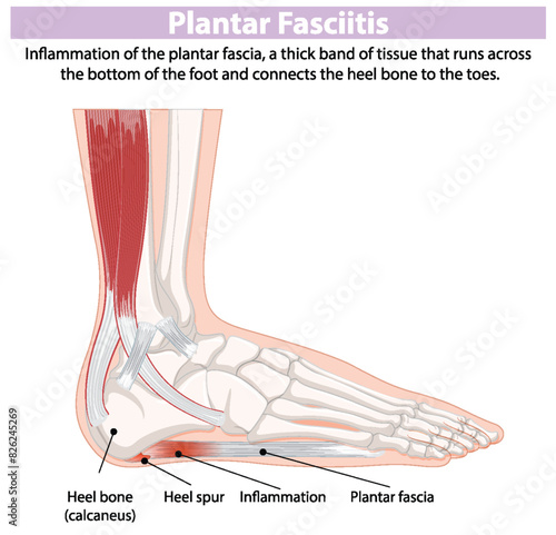 Detailed diagram of plantar fasciitis in the foot