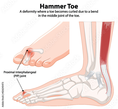 Diagram showing hammer toe deformity and anatomy