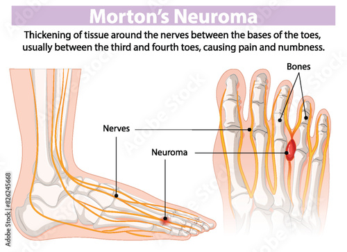 Diagram showing nerves and neuroma in the foot