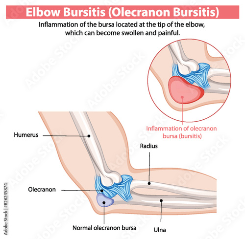Inflammation of the olecranon bursa in the elbow