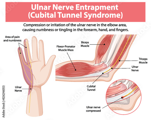 Detailed diagram of cubital tunnel syndrome
