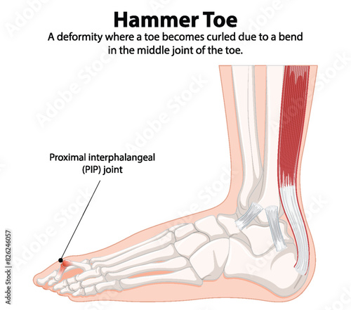 Diagram showing hammer toe deformity and PIP joint