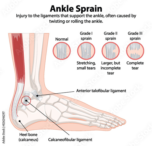 Detailed diagram of ankle sprain types