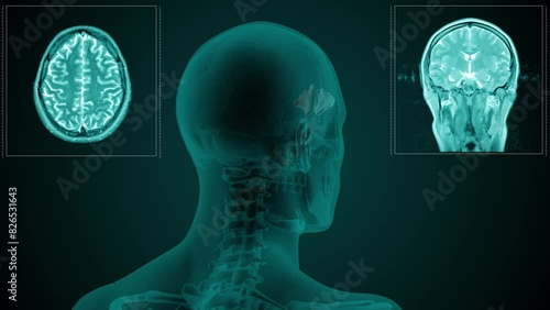 Magnetic resonance scan of the head of a man with visible paranasal Frontal sinus. Anatomically correct 3d animation on dark background