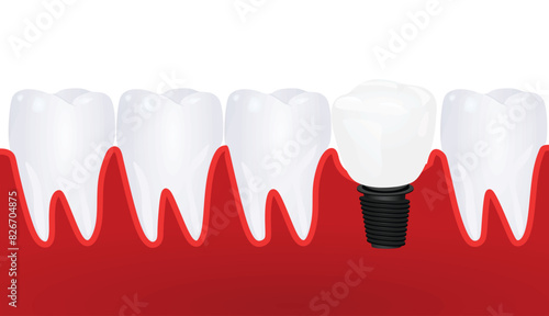 Dental implementation teeth. vector illustration