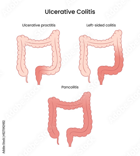 Types of Ulcerative Colitis in Humans