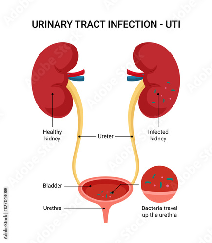Urinary Tract Infection UTI Symptoms