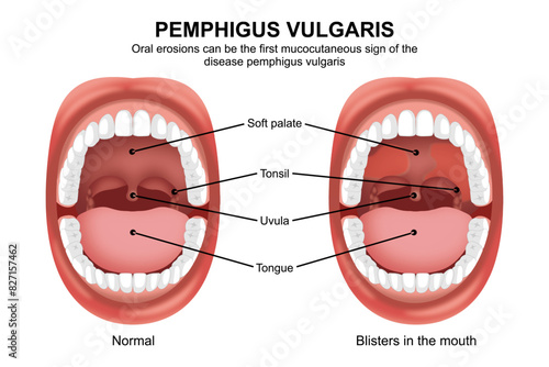 Pemphigus vulgaris mouth disease illustration