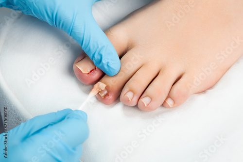 The podiatrist examines the nail and applies an antifungal treatment