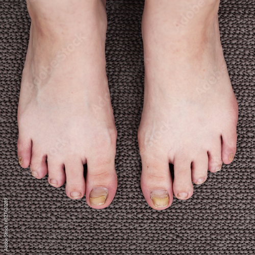 Problems with toenails. Damaged thumb nails. Mycosis on the legs, detaches from the finger. Problems after pedicure, treatment of fingers from disease