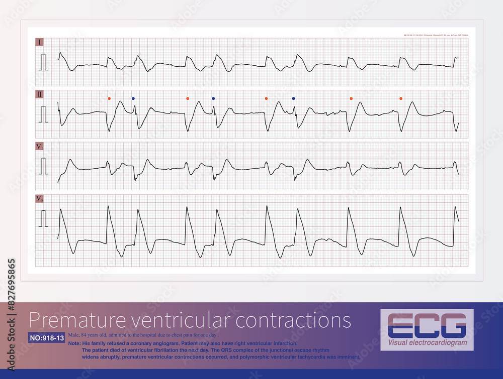 A patient with AIMI presents with a sudden widening of the QRS complex in the junctional escape rhythm, premature ventricular contractions, resulting in  polymorphic ventricular tachycardia.
