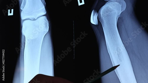 Doctor examining osteoid osteoma, benign bone tumor. X-ray and MRI, MRT, CT with marked sclerosis around the nidus. Medical treatmant concept. Diagnosis of the disease humans bones. photo
