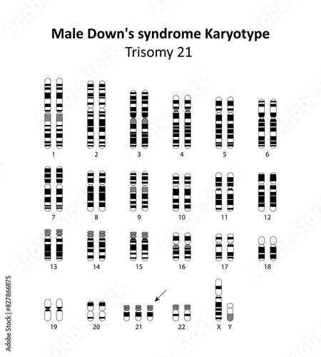 Male Down's syndrome (trisomy 21) human karyotype	