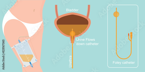 Urinary catheter is a flexible tube used to empty the bladder.