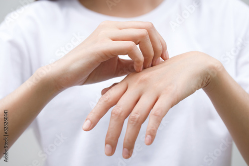 Bild auf Leinwand Health problems, woman has itchy hands