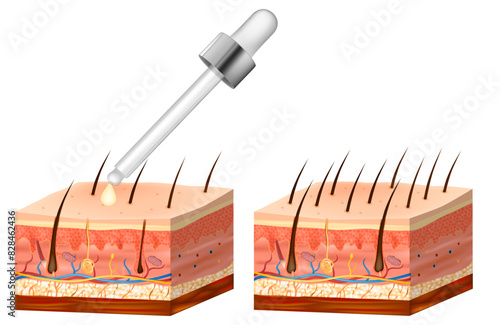 Treatment of alopecia vitamins hair. Number of hair on scalp before and after of treatment loss.