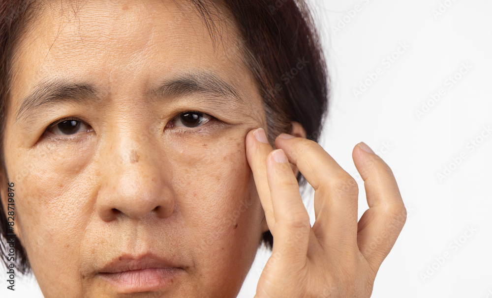 Flabby and wrinkled skin on senior woman face. Flabby and wrinkled skin on senior woman face.