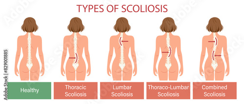 Types of scoliosis, spinal disease. Infographics banner with human scoliosis spine. Healthcare and medicine. Illustration, poster