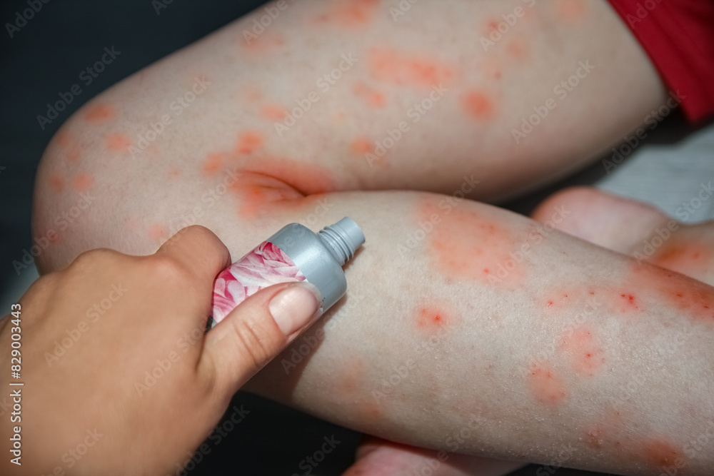 atopic dermatitis on the legs of a child atopic dermatitis on the legs of a child