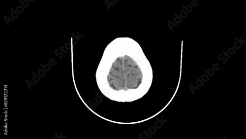 normal head ct scan brain window  photo