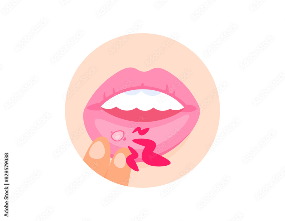 illustration of a hand pulling the lips because of canker sores. mouth ulcers. diseases of the lips or mouth. inner lip hurt. infection and inflammation. health problems. flat illustration design illustration of a hand pulling the lips because of canker sores. mouth ulcers. diseases of the lips or mouth. inner lip hurt. infection and inflammation. health problems. flat illustration design