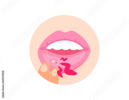 illustration of a hand pulling the lips because of canker sores. mouth ulcers. diseases of the lips or mouth. inner lip hurt. infection and inflammation. health problems. flat illustration design