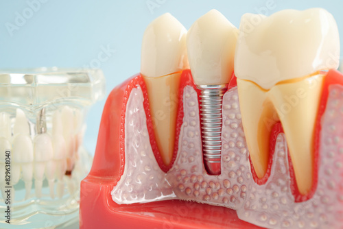 Artificial tooth roots dental implant into jaw, Root canal model for dentist. photo