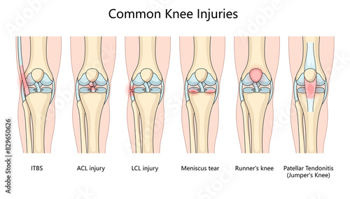 Photography various common knee injuries, LCL injury, meniscus tear, runner's knee, and patellar tendonitis structure diagram hand drawn schematic raster illustration