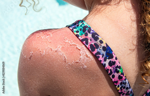 Close up view of child shoulder with severe sunburn. Red skin with dead skin peeling off outdoors by the pool.