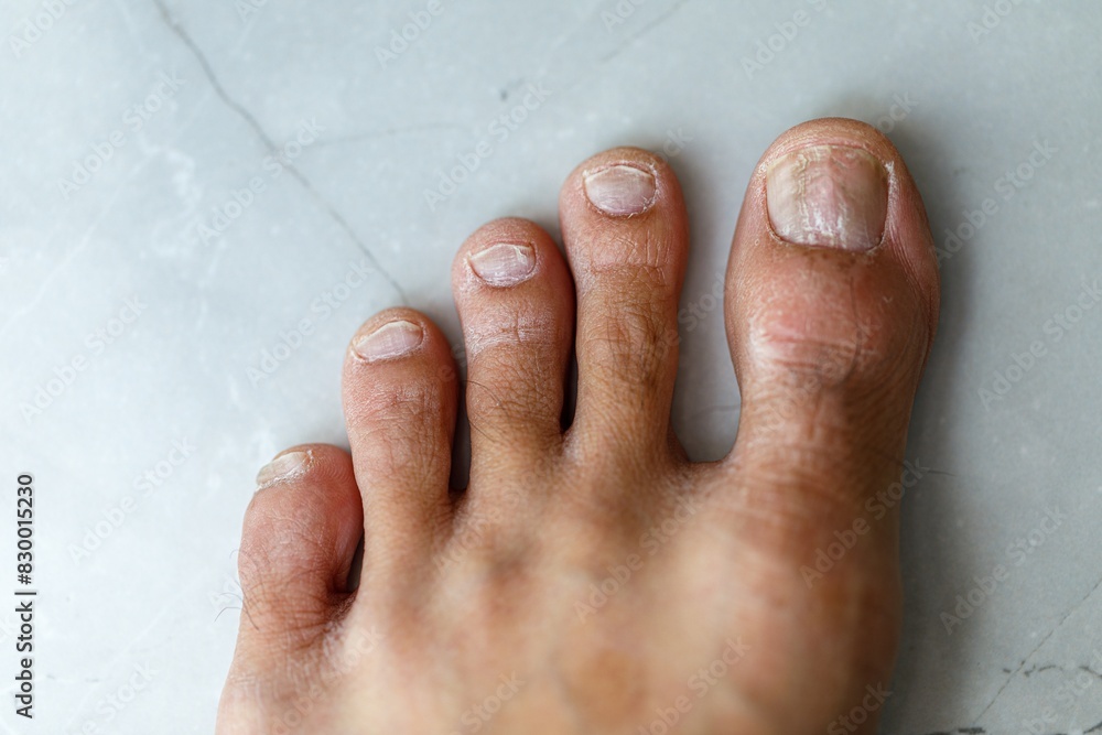 Top view of the foot and Brittle toenail causing nail surface layers or lamella to peel away with some parts splitting or breaking off. Top view of the foot and Brittle toenail causing nail surface layers or lamella to peel away with some parts splitting or breaking off.