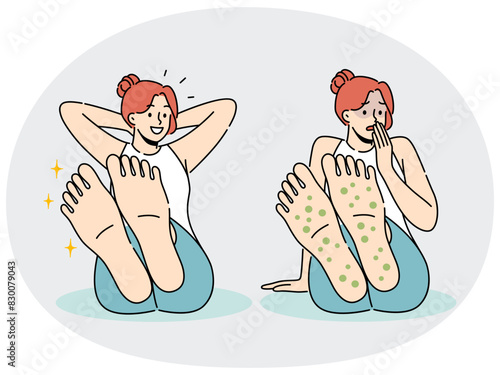 Woman with rash on feet suffers from allergies and fungal infection that causes severe itching and odor. Sad and happy girl before and after applying healing cream to fight fungus on feet