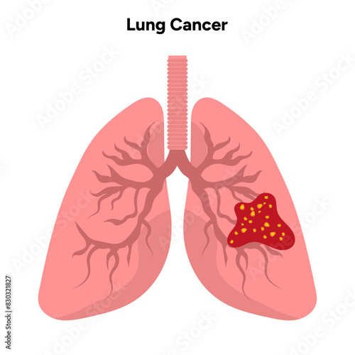 Lungs cancer medical disease illustration 
