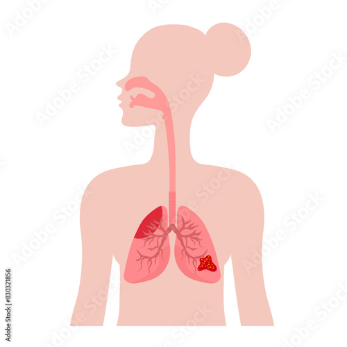 Unhealthy lungs