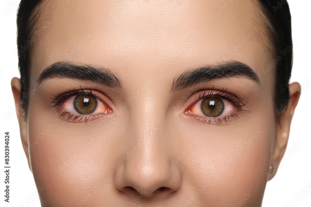 Woman with red eyes suffering from conjunctivitis on white background, closeup Woman with red eyes suffering from conjunctivitis on white background, closeup