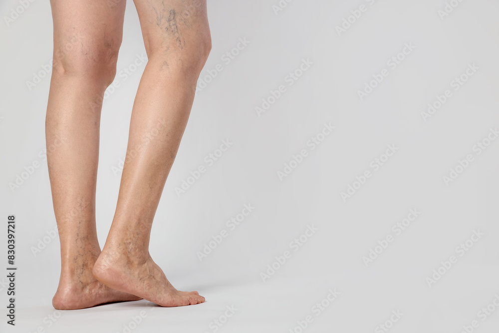 Closeup view of woman with varicose veins on light background. Space for text Closeup view of woman with varicose veins on light background. Space for text