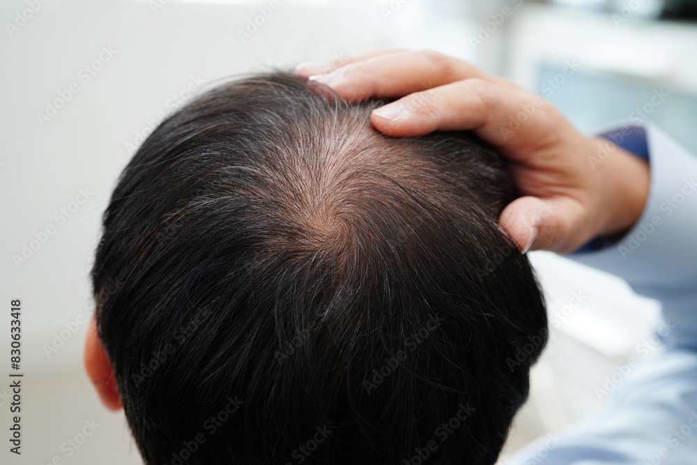 Naklejka premium Bald head in man, hair loss treatment health problem.