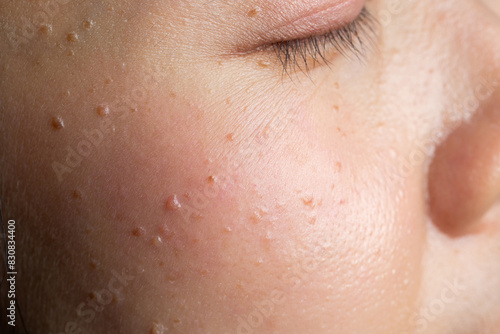 Seborrheic keratosis, pore, acne and wrinkles in face woman skin macro. Facial care skin problems for beauty and cosmetic background concept.	