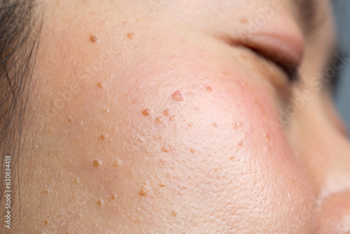 Wallpaper Mural Closeup seborrheic keratosis, pore, acne and wrinkles in face woman skin macro. Facial care skin problems for beauty and cosmetic background concept.	 Torontodigital.ca