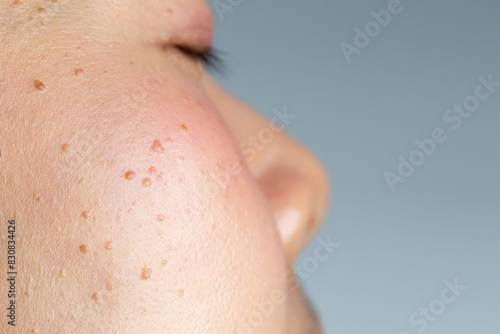 Seborrheic keratosis, pore, acne and wrinkles in face woman skin macro with empty space. Facial care skin problems for beauty and cosmetic background concept.	