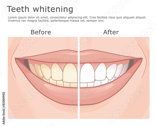 Teeth whitening before and after medical illustration
