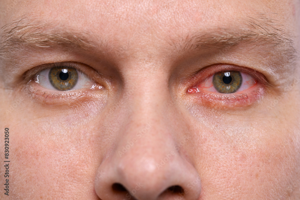 Fototapeta premium Man with red eye suffering from conjunctivitis, closeup