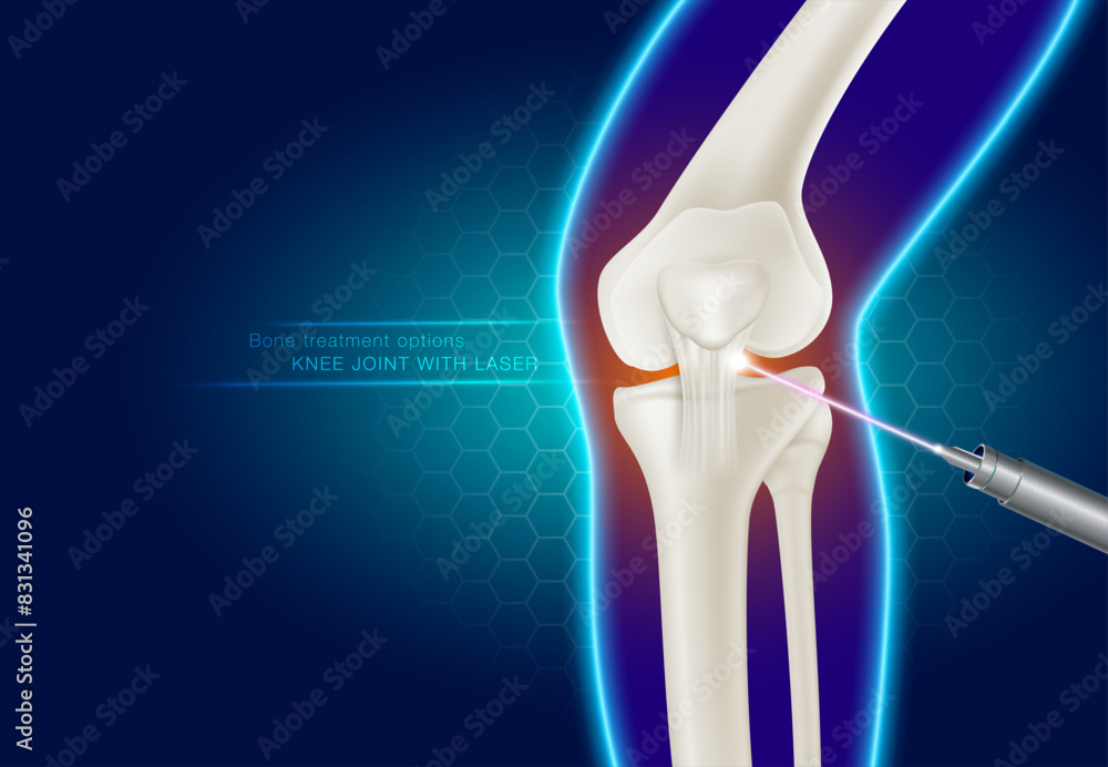 View of Laser treatment of knee joints Modern medical technology for treating ...