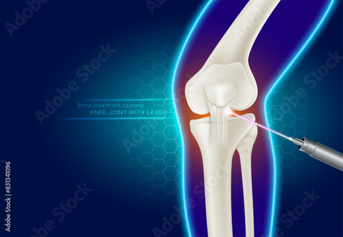 Laser treatment of knee joints Modern medical technology for treating joint injuries Reduce injuries and joint pain. Realistic vector illustration.