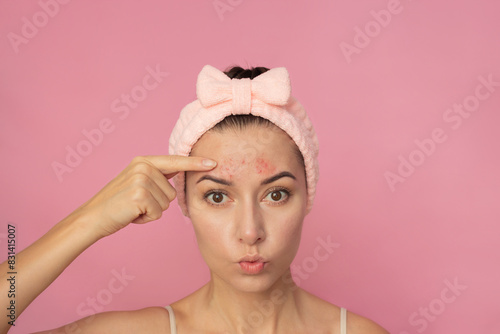 A young Caucasian brunette woman with a pink headband looking at camera and showing the pimples on her forehead with her index finger in surprise. Isolated on a pink background. Chronic acne. Rosacea photo