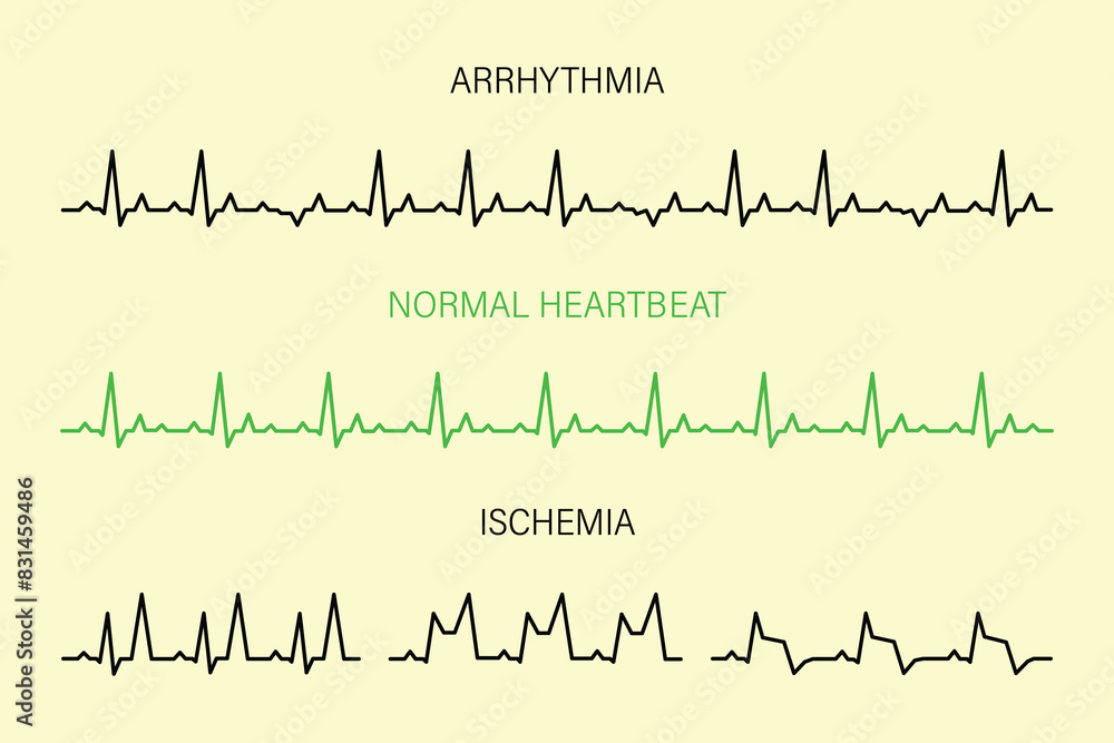 Set Lines heartbeat normal arrhythmia and ischemia, heartbeat make a heart symbol