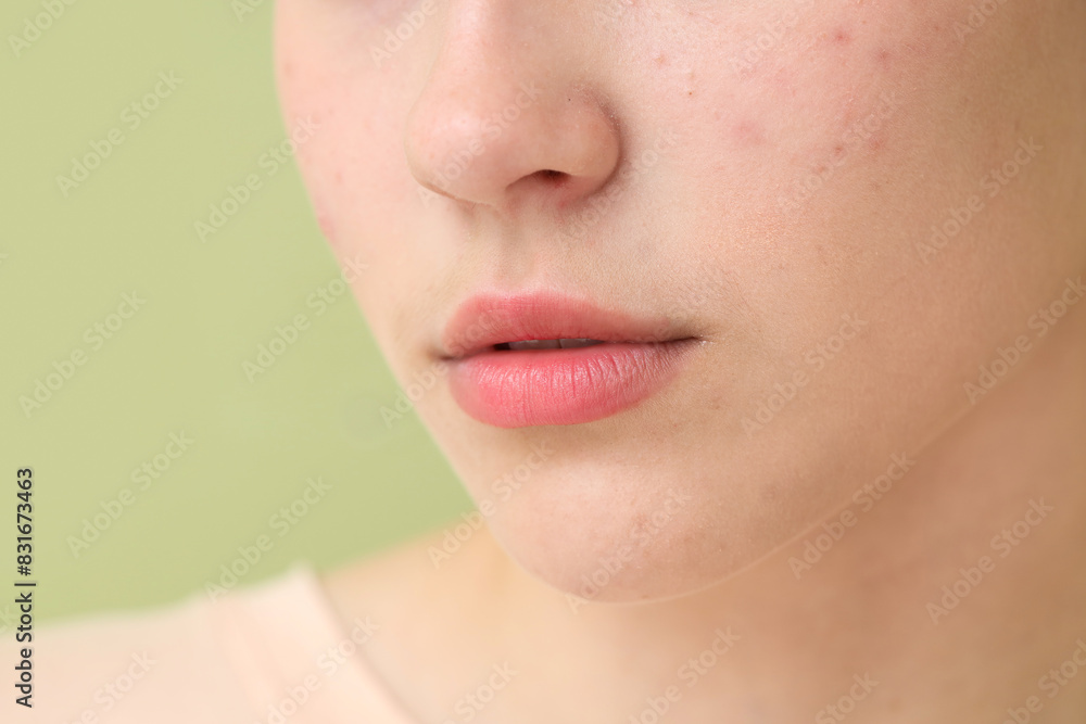 Obraz premium Beautiful young woman with acne problem on green background, closeup