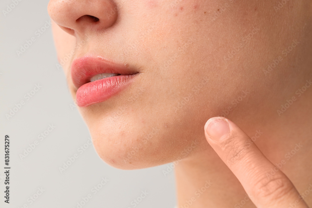 Beautiful young woman with acne problem pointing at her skin on grey background, closeup Beautiful young woman with acne problem pointing at her skin on grey background, closeup