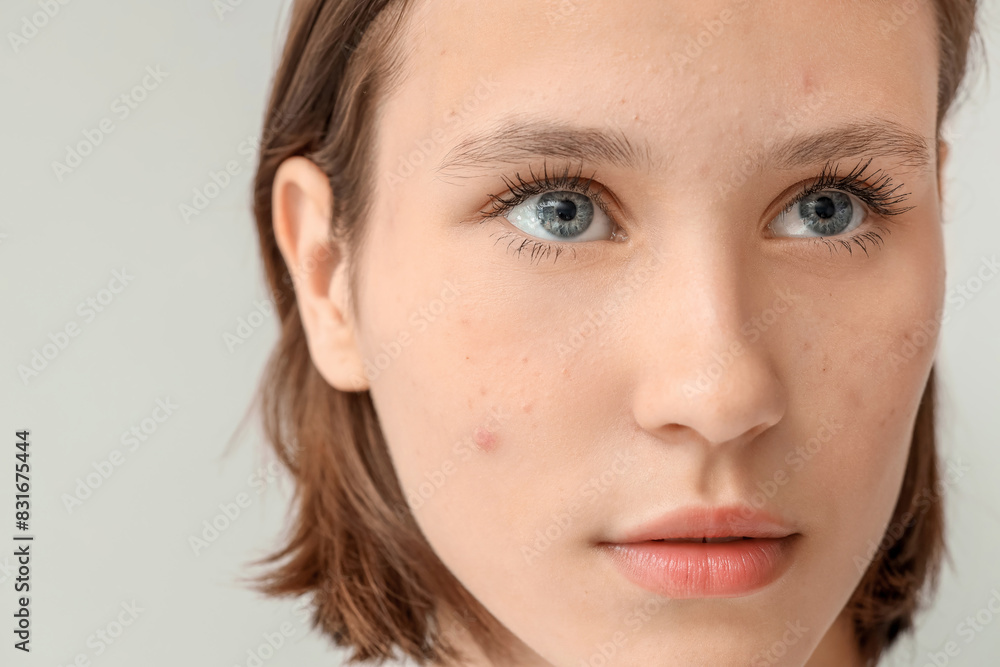 Fototapeta premium Beautiful young woman with acne problem on grey background