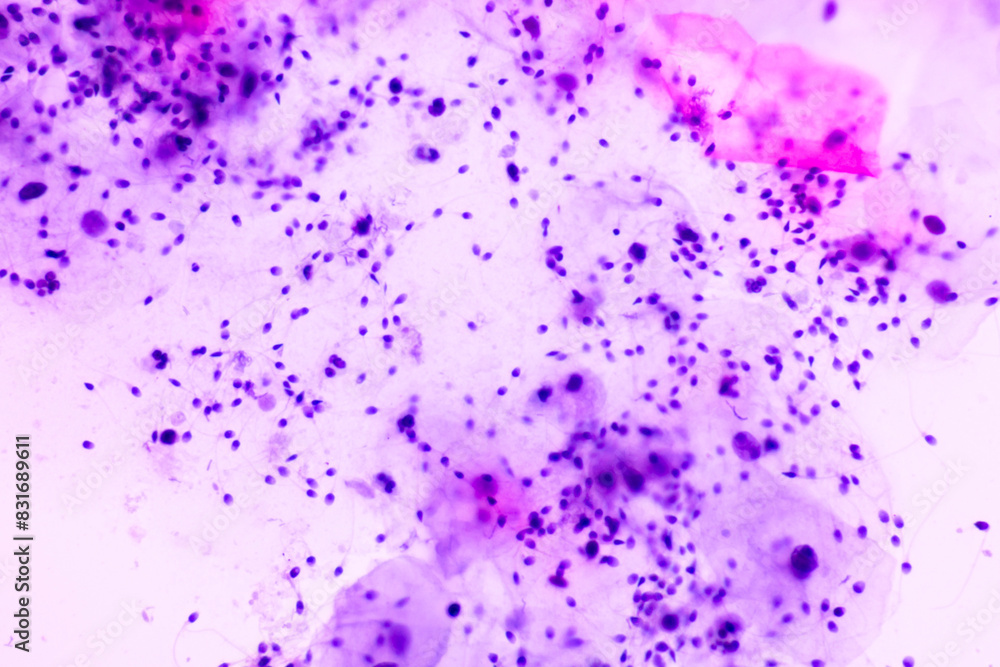 Human sperms viewed in the microscopic for male fertility test.Spermatozoa on white background.Reproductive system check.Donor suitability test for artificial insemination.Semen analysis. Human sperms viewed in the microscopic for male fertility test.Spermatozoa on white background.Reproductive system check.Donor suitability test for artificial insemination.Semen analysis.